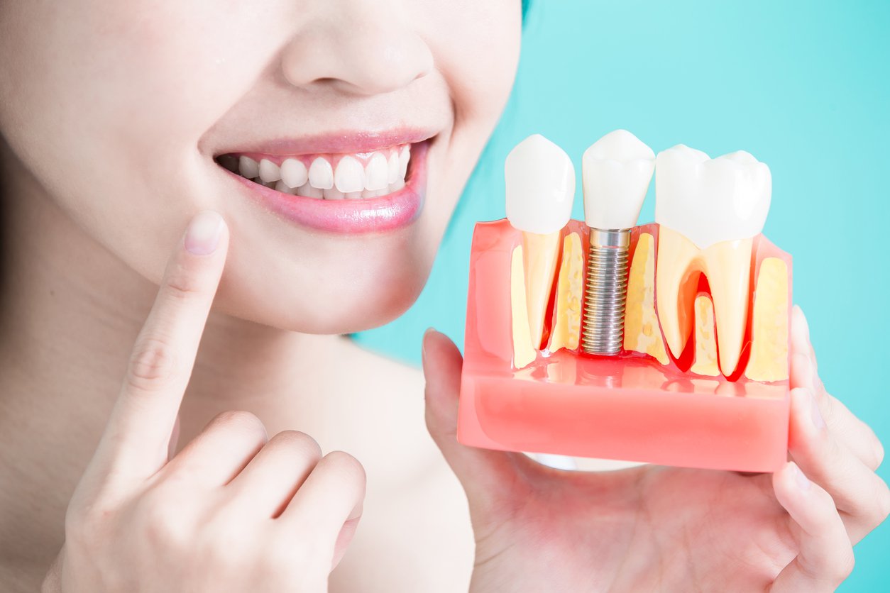 Trồng răng Implant bao lâu thì hết đau